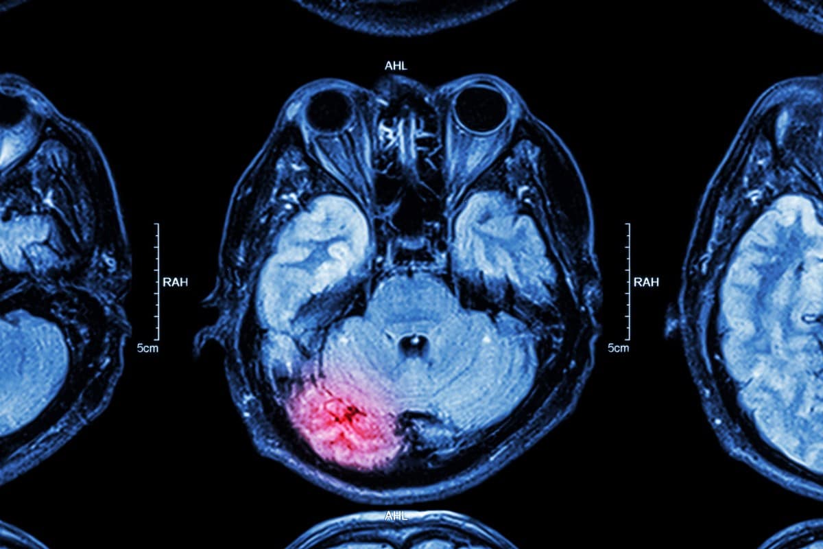 Traumatic Brain Injury Recovery Stages