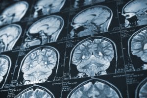 What Short-Term and Long-Term Complications May Arise from Brain Injuries?