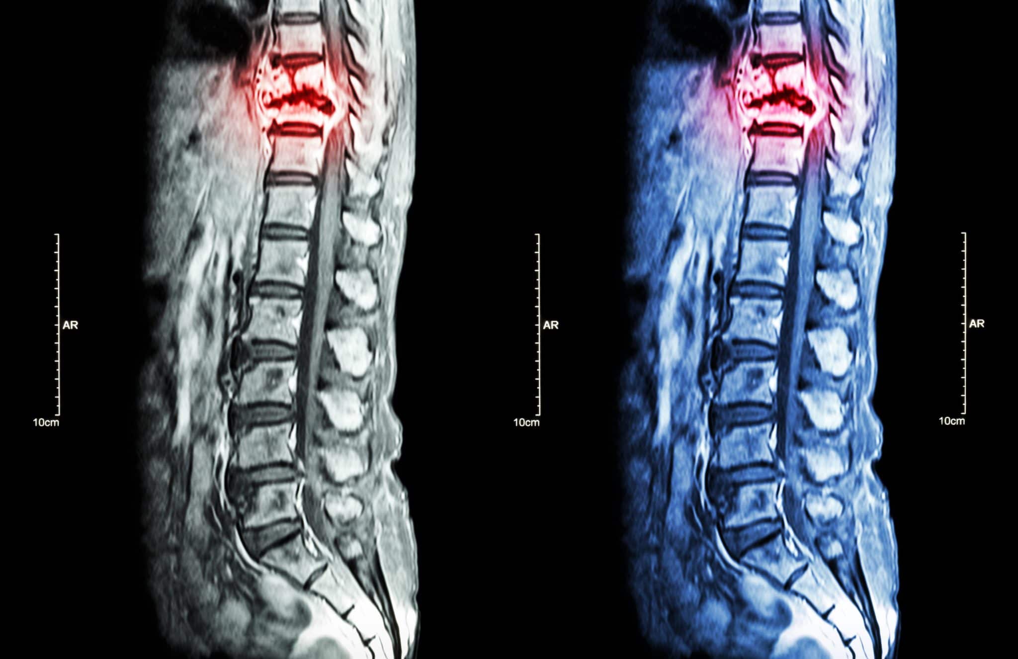 Spinal Cord Injuries, Neuropathy, and Car Accidents Philbrook Law
