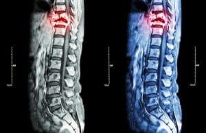 Spinal Cord Injuries, Neuropathy, and Car Accidents