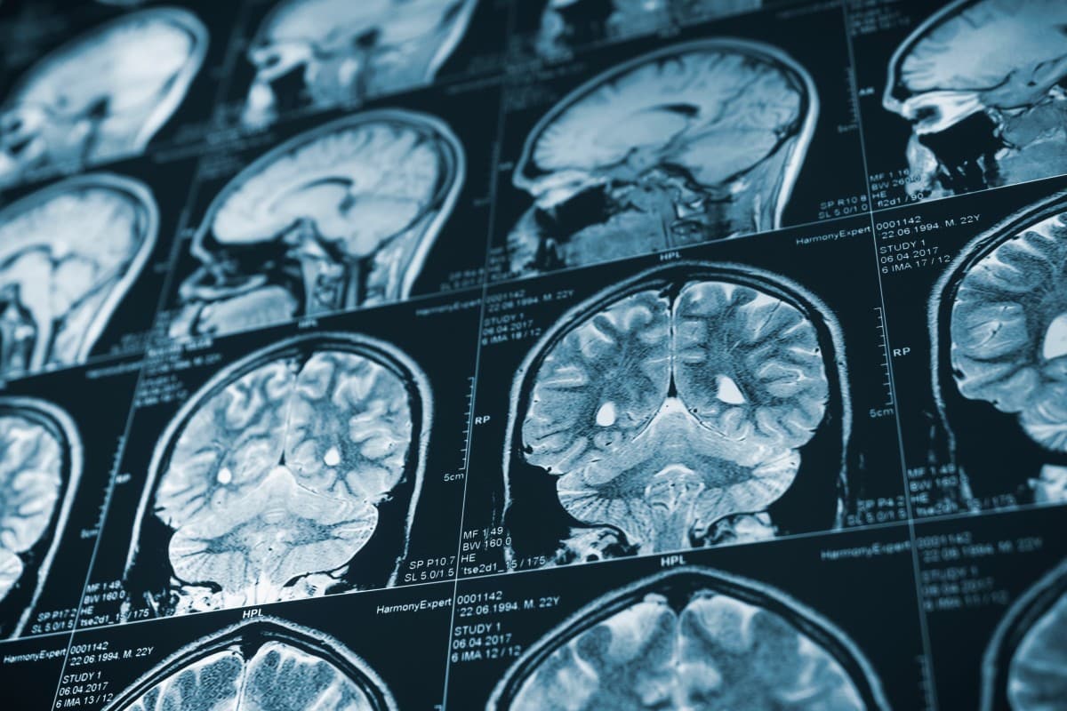 Traumatic Brain Injury Lawsuit Filed Against Two Stars of Jackass