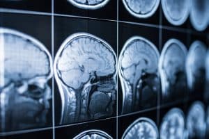 Why TBIs Are Often Undiagnosed